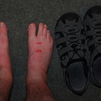 I put sunscreen everywhere except my feet