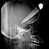 x ray of a knife in head
